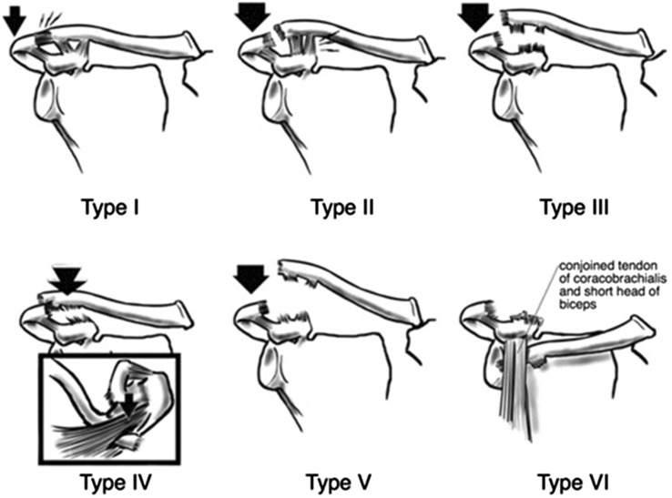 Rockwood classification_AC joint injury types